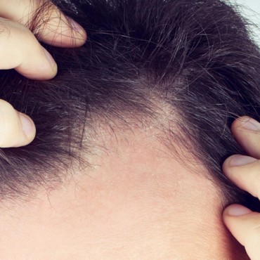 Tratament-alopecie